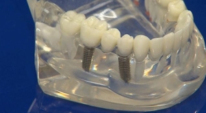 Samsun'da yerli ve milli imkanlarla implant üretildi