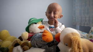 Nadir görülen genetik bir hastalık: Progeria