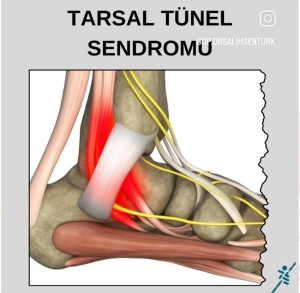TARSAL TÜNEL SENDROMU
