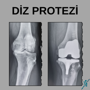 DİZ PROTEZİ