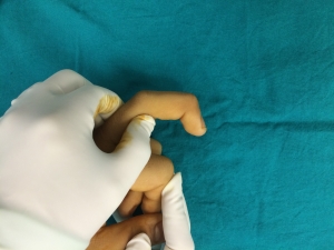 Çekiç Parmak Deformitesi ( Mallet Finger)